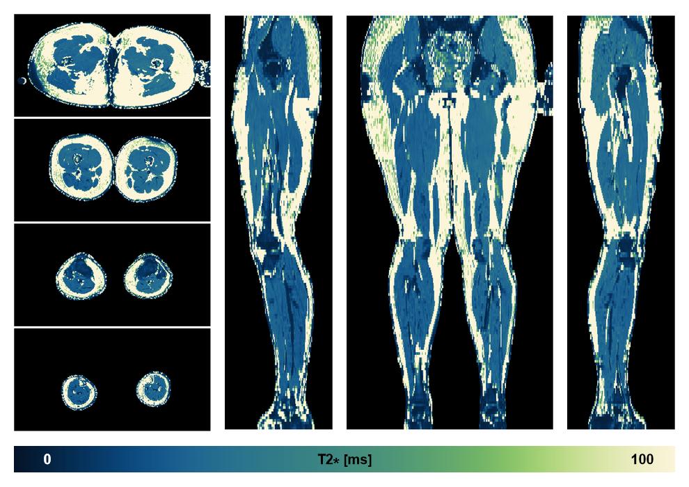 The T2 star relaxation time of the lower extremity obtained from the dixon reconstruction for muscle water fat quantification.